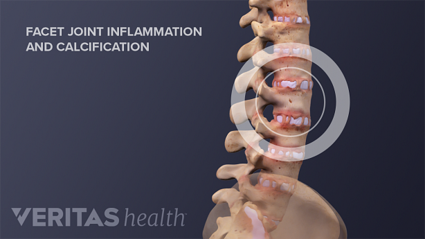 Illustration of vertebral spine with facet joint inflammation and calcification.