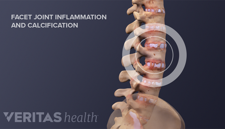 Illustration of vertebral spine with facet joint inflammation and calcification.