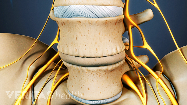 A close up view of two vertebrae showing fibrosus calcification between the discs