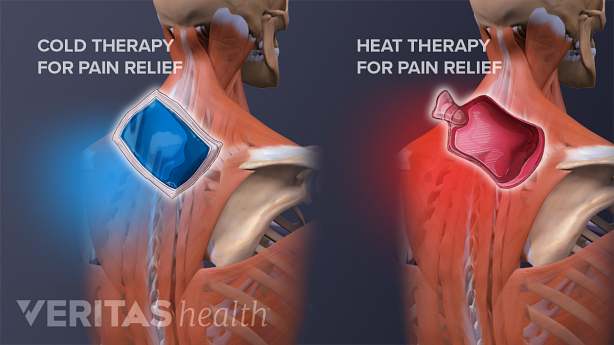 Illustration showing posterior view of adult back with heat pack and ice pack in the neck region.