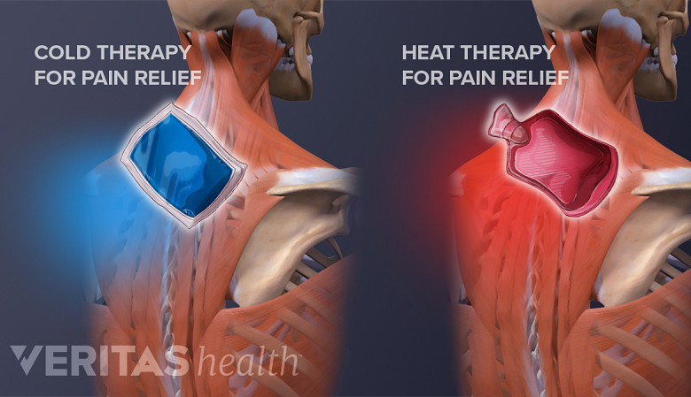 Illustration of 2 posterior view of torso, one with cold pack icon and the other one with heat pack icon near the neck.