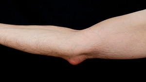 Profile view of inflammation and swelling in the elbow