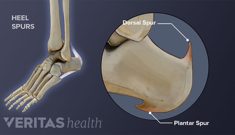 Bone spurs in the heel.