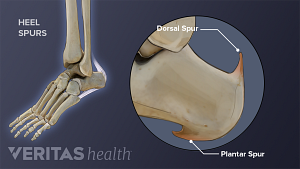 Illustration showing plantar spur and dorsal spur on the heel