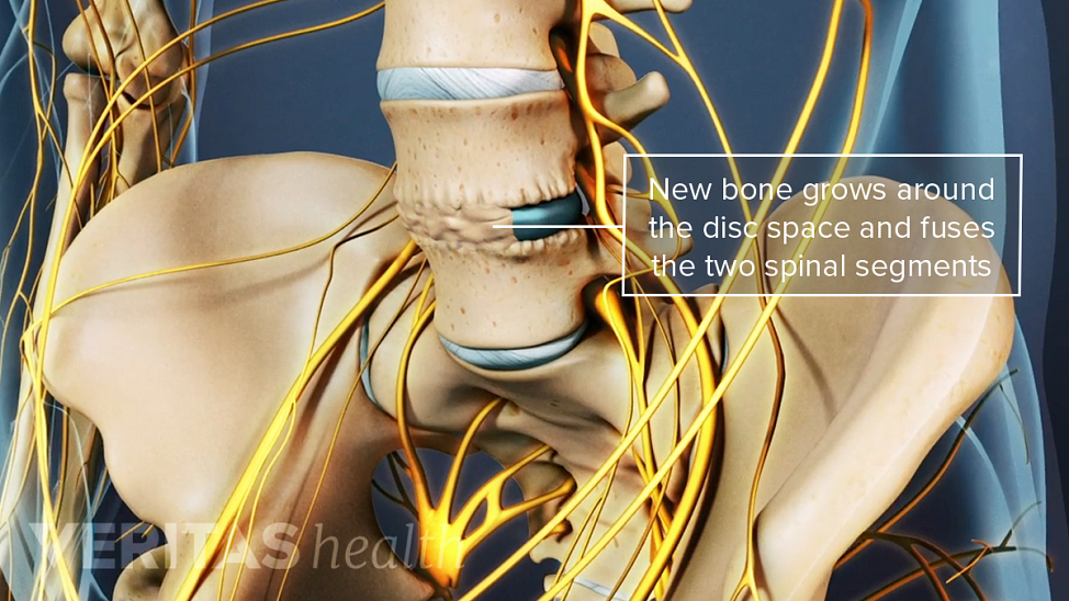 New bone grows around the space and fuses the two spinal segments