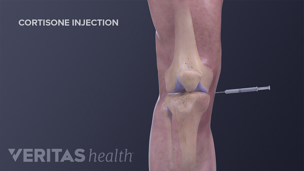 Medical illustration of a cortisone injection for the knee to treat osteoarthritis