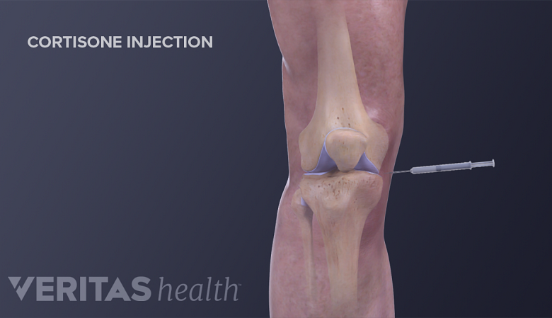 A cortisone injection going into the knee