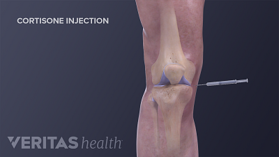 Medical illustration showing a cortisone injection into the knee
