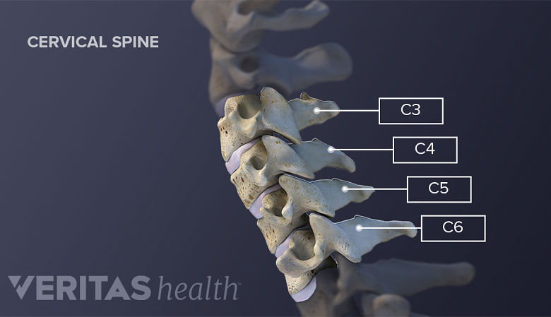 Cervical Spine Fusion C3-C5 ACDF
