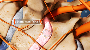 Ilustración médica que muestra una hernia de disco en la columna cervical.