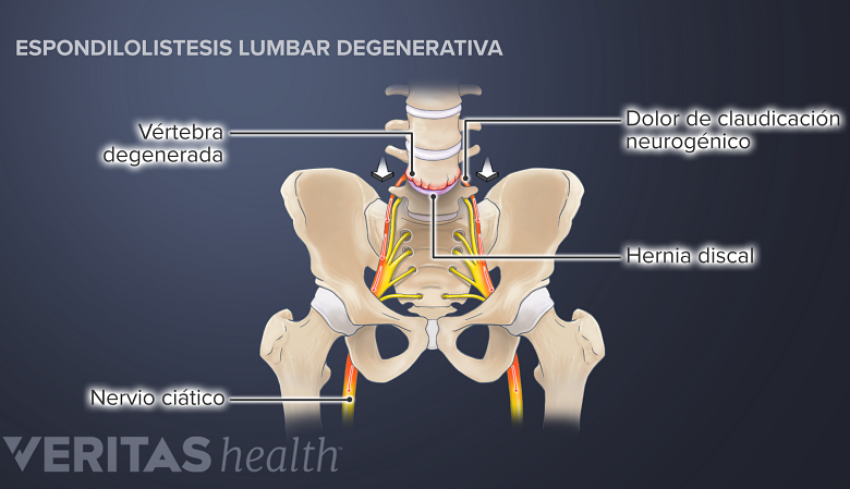 Ilustración espondilolistesis degenerativa en el segmento espinal L4-L5 que causa dolor de claudicación neurogénica.