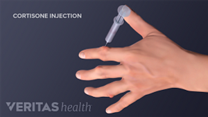 Cortisone injection in the pointer finger