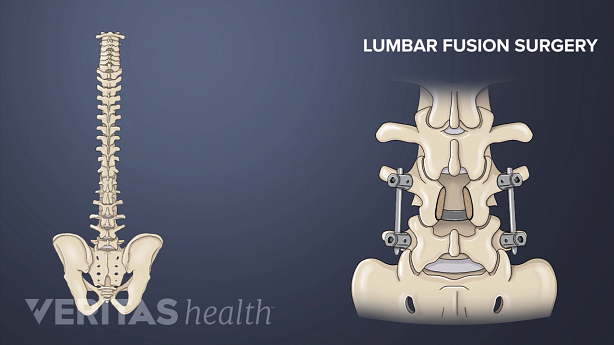 Posterior view illustration of a lumbar fusion.