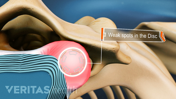 Superior view of weak spots in the disc between vertebra.