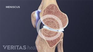 Cross section of the knee highlighting the meniscus