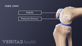 Bones in the knee affected the patellofermoral alignment