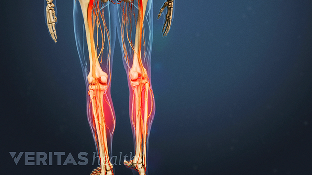 Nerve pain in the thigh and calf area of the leg.
