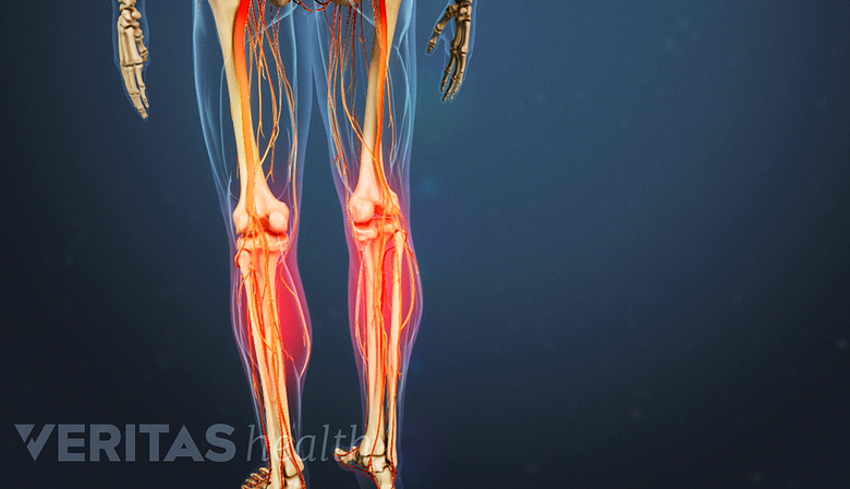 Nerve pain in the thigh and calf area of the leg.