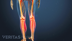 Medical illustration of the leg bones. The shins are highlighted in red to indicate pain