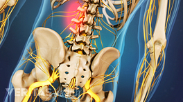 Posterior view of the lumbar spine and pelvis showing pain in the spine.