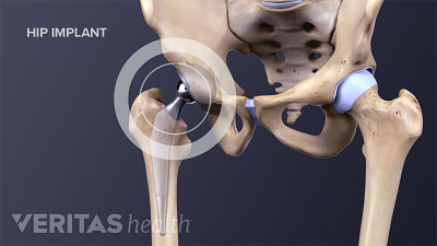 Medical illustration of a completed hip implant