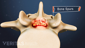 Ilustración médica de estenosis espinal lumbar y espolones óseos
