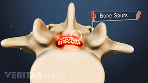 Superior view of a vertebra highlighting bone spurs encroaching on the spinal cord.