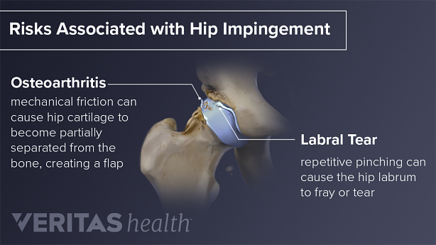 Shown are is osteoarthritis and labral tear which are risks associated with hip impingement