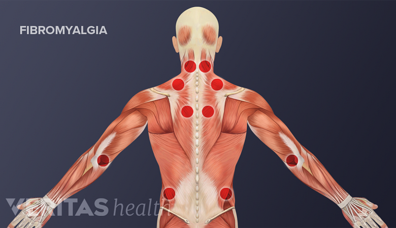 Medical illustration of fibromyalgia tender points.