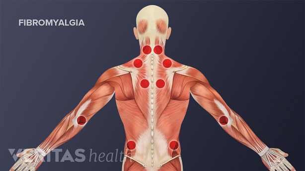 Medical illustration of fibromyalgia tender points.