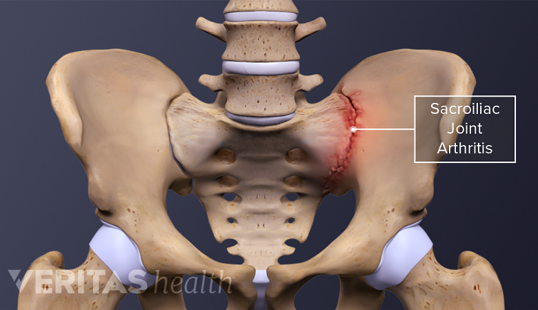 illustration of SI joint arthritis on the left side of the pelvis.