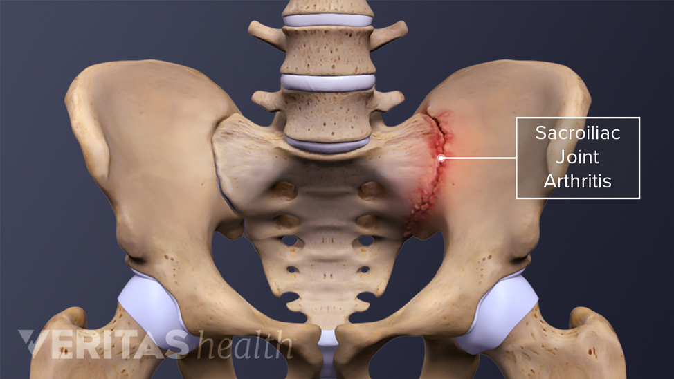 Anterior view of the SI JoInt labeling sacroiliac joint arthritis