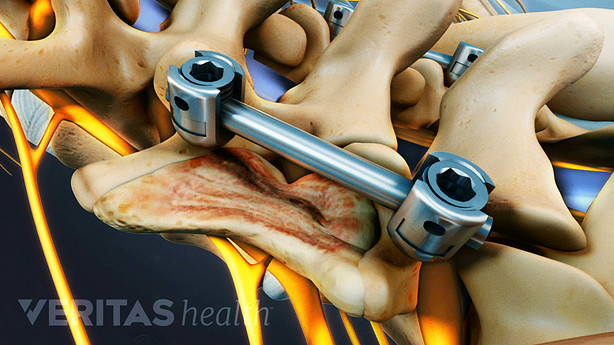 Pedicle screws and rods being used in a spinal fusion.