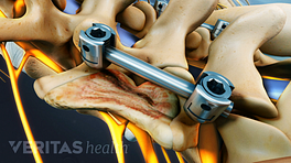Fusion rods in the lumbar spine.