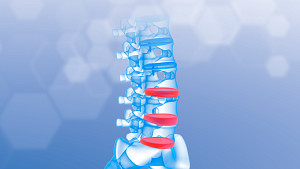 Anterior view of a lumbar spine highlighting the disc spaces.