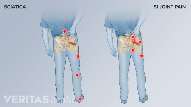 Two diagrams showing the differing pain points of sciatica and si joint pain.