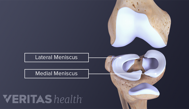 Illustration showing anatomy of knee joint labelling lateral miniscus and medial meniscus.