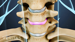 Close up view of cervical vertebrae, a disc between two vertebrae is highlighted in pink