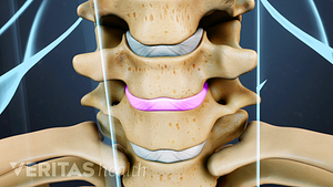 Close up view of cervical vertebrae, a disc between two vertebrae is highlighted in pink