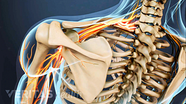 Posterior view of the upper back showing pain radiating in the shoulder