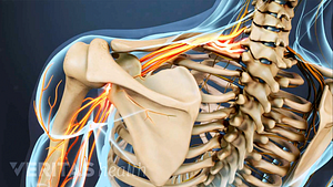 Posterior view of the upper back showing pain radiating in the shoulder