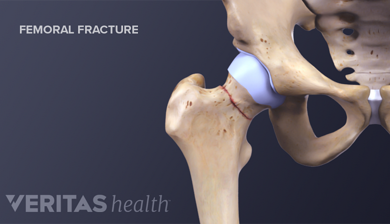 Total hip replacement surgery: what is the procedure?