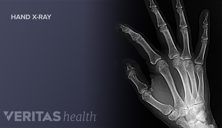 Illustration showing hand wrist x-ray.