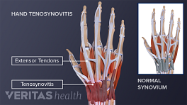 Trigger Finger: Causes, Symptoms, and Treatment Options - Philadelphia Hand  to Shoulder Center