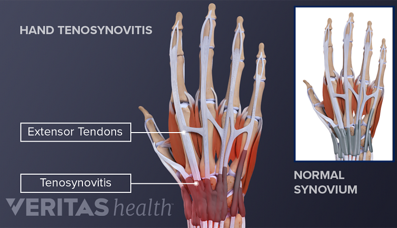 illustration of the anatomy of an adult hand with tenosynovitis of the flexor tendons