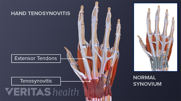Hand tenosynovitis highlighting the extensor tendons and comparing it to the normal synovium
