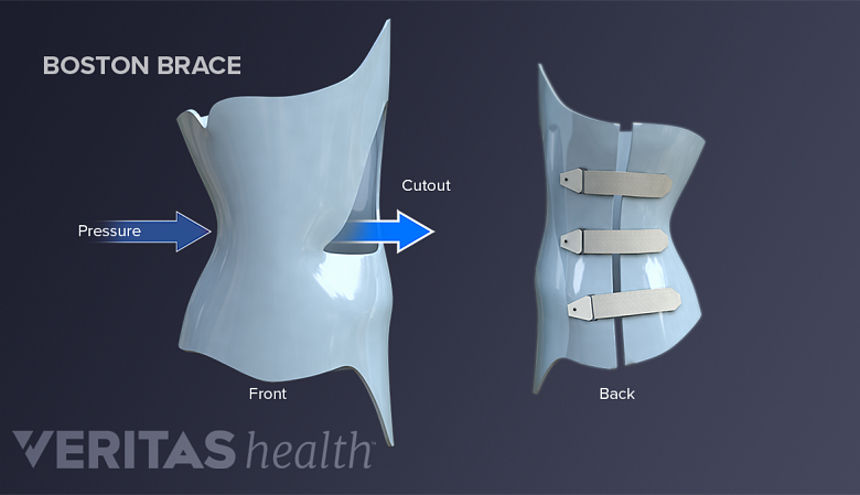 TLSO Thoracic Full Back Brace- Thoracic Lumbar Sacral Orthotic Compression  Fractures Upper Spine Injuries Pre or