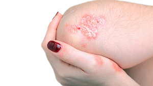 close up of elbow with psoriasis