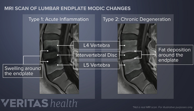 Side by side view of modic changes on an MRI scan