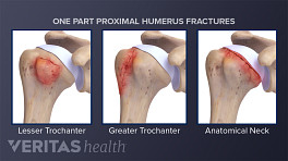 Examples of one part proximal humerus fractures